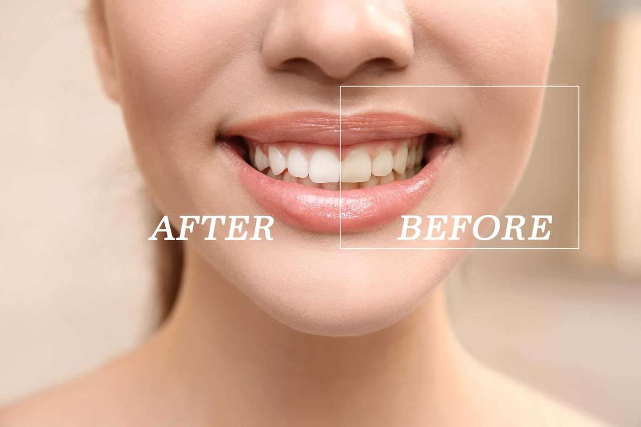 What Are the Most Effective Natural Teeth Whitening Methods You Can Try Hertford?