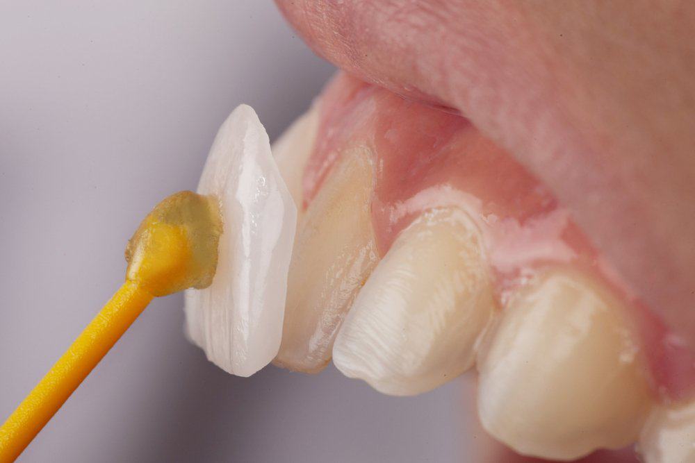 Why Do Dental Crowns Fail or Get Damaged Prematurely Hertford?
