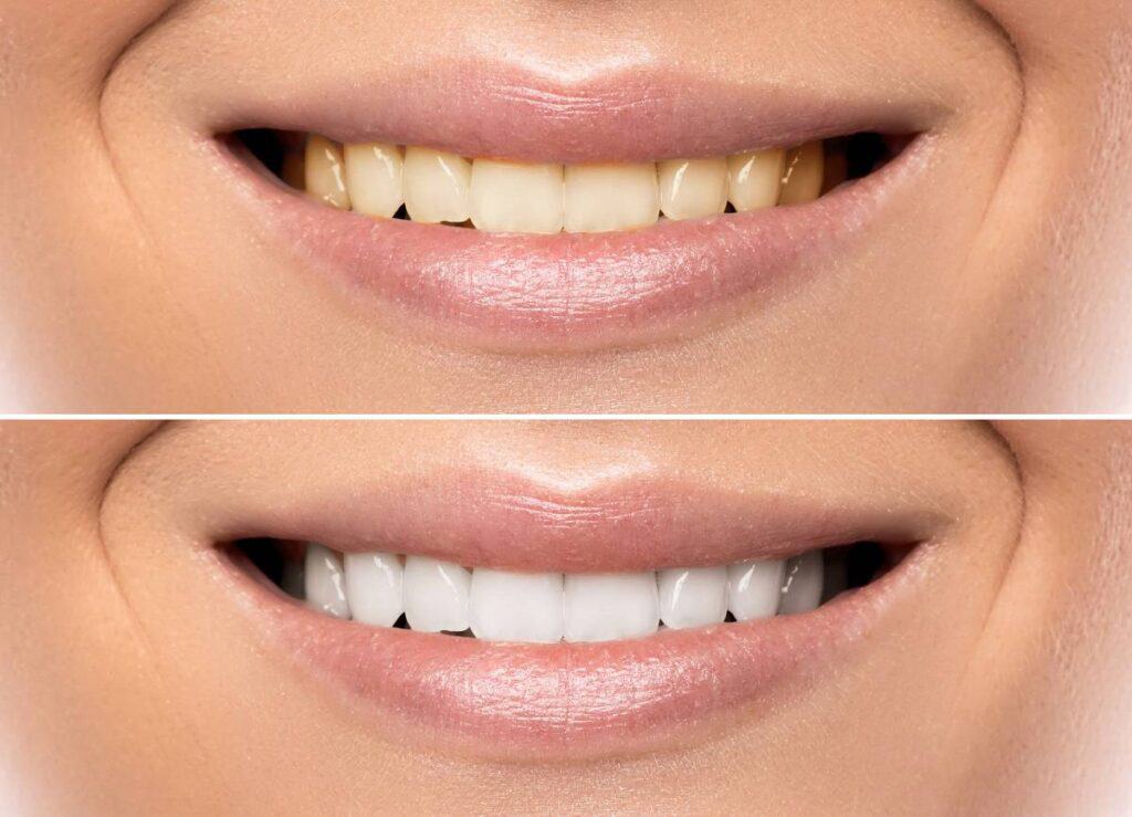 How Does Gum Disease Progress if Left Untreated Hertford?