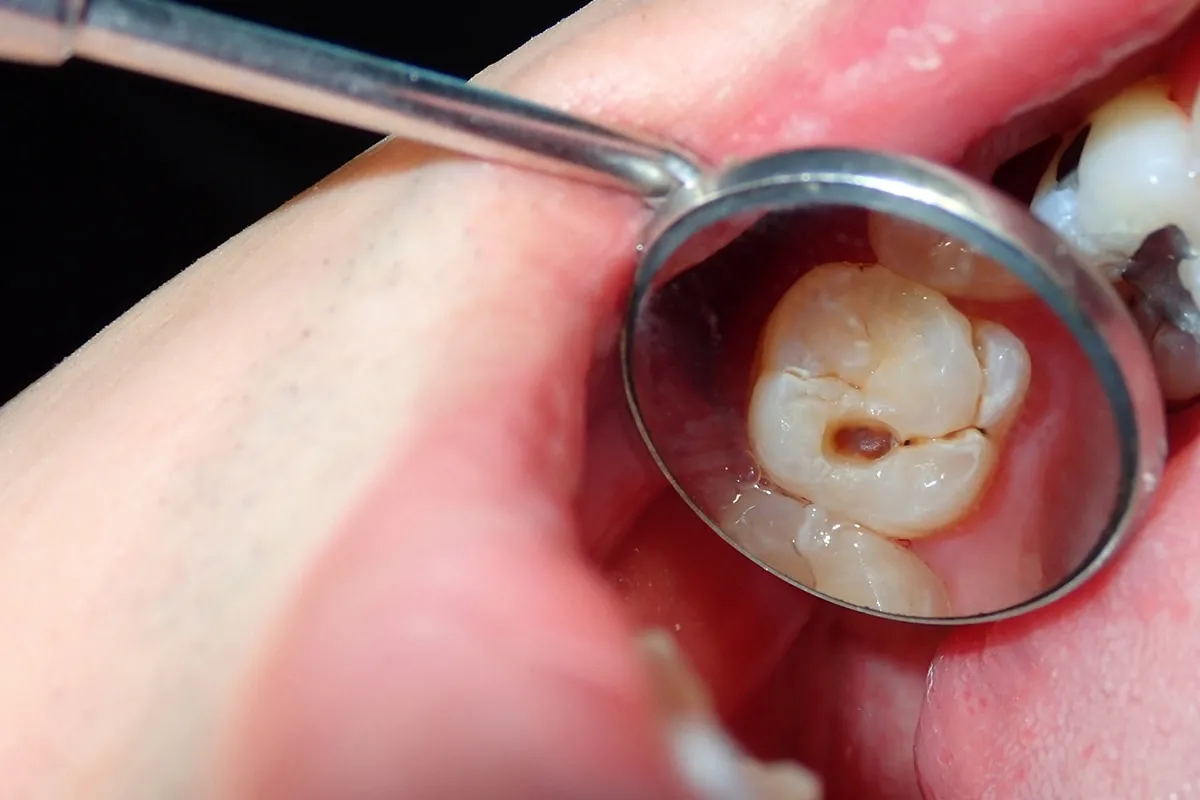 Why Do Teeth Crack? Common Causes to Know Hertford
