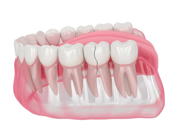 How Can You Manage Pain and Discomfort After a Root Canal Hertford?