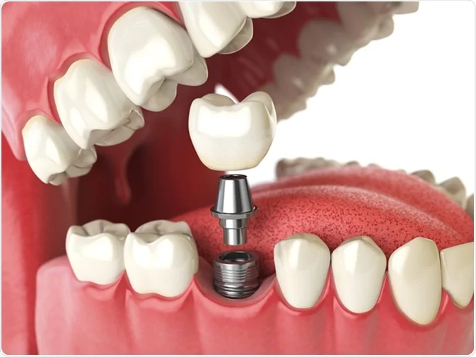 How Do I Decide Which Tooth Replacement Is Right for Me Hertford?