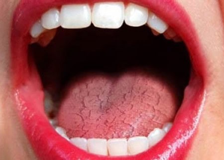 Common Causes of Dry Mouth (Xerostomia) Hertford
