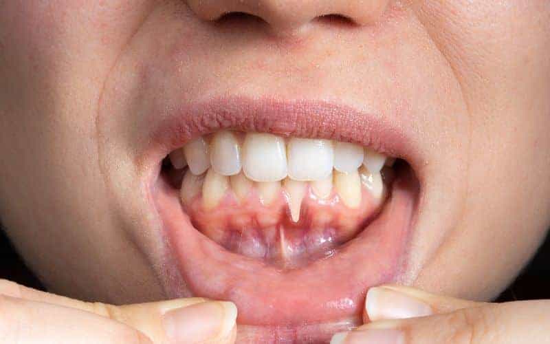 How Can Gum Disease Be Prevented Hertford?
