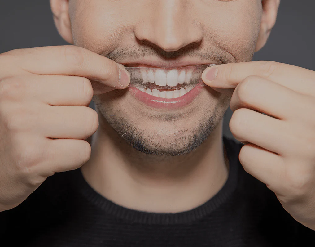 What to Consider Before Choosing a Teeth Whitening Option Hertford