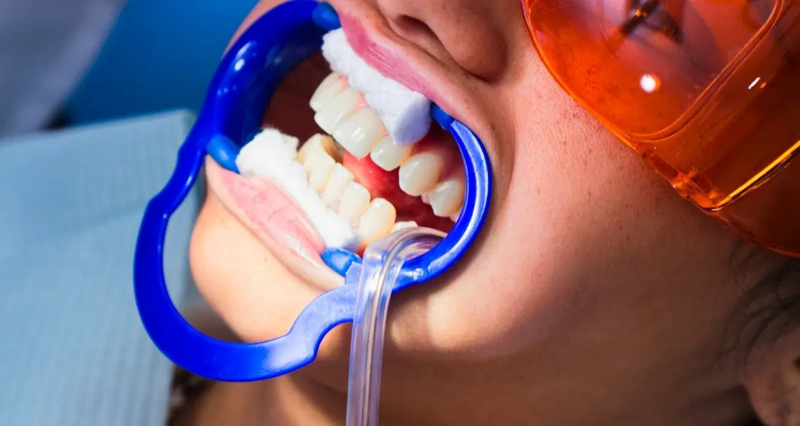 How Can You Prevent the Need for a Root Canal in the Future Hertford?