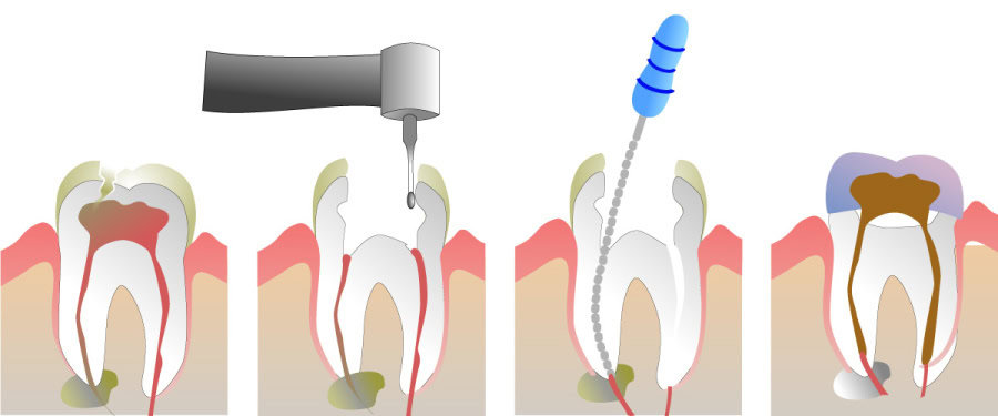 How Do You Properly Care for Your Teeth After a Root Canal Hertford