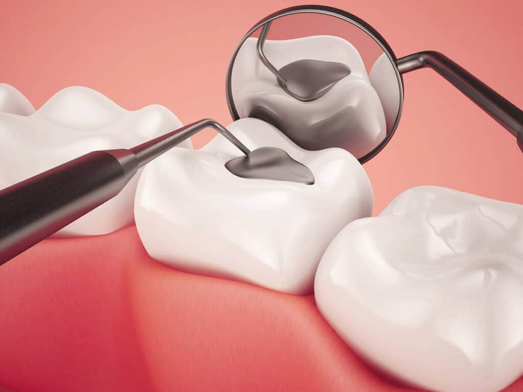 Fighting Cavities and Plaque Buildup Hertford
