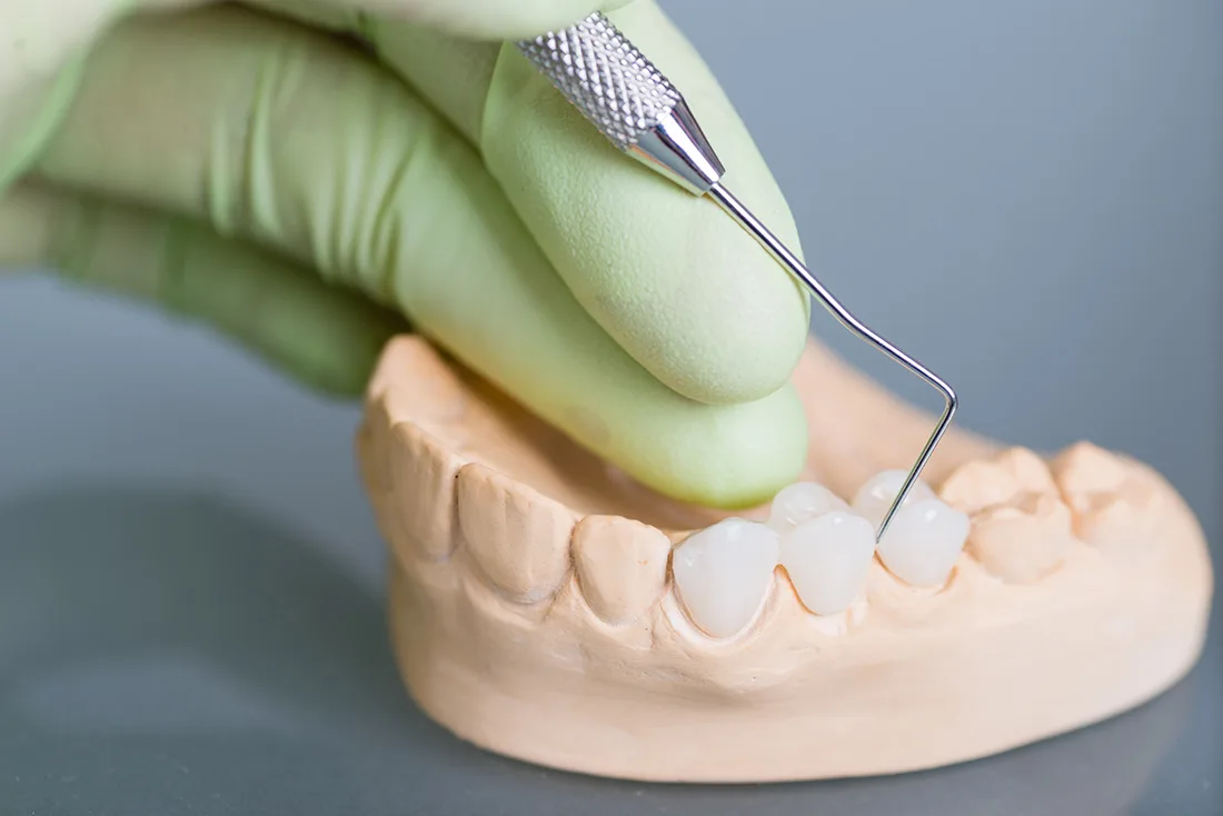 What Are the Different Types of Dental Crowns Available Hertford?
