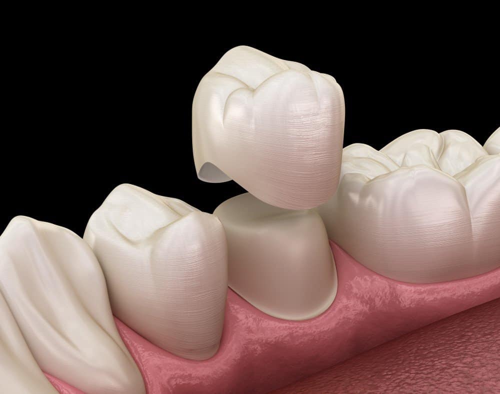 How Can You Prevent Common Dental Crown Problems Hertford?