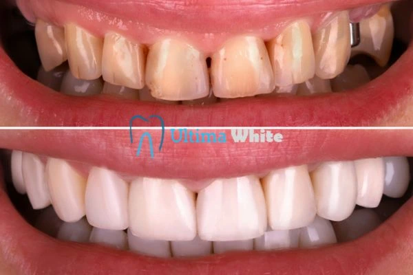 What Makes Instant Teeth Whitening Treatments So Popular Hertford?