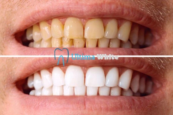 Stained Teeth and Persistent Bad Breath Hertford
