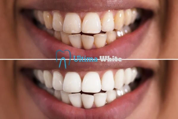 Aftercare Tips to Maintain Your New Smile Hertford